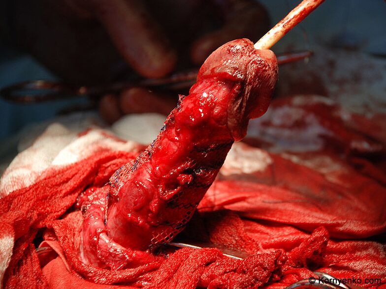 collagen matrix installation for penis enlargement