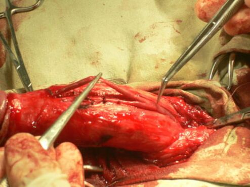 undergoing penis enlargement surgery