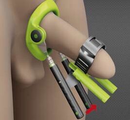recovery after penile enlargement surgery